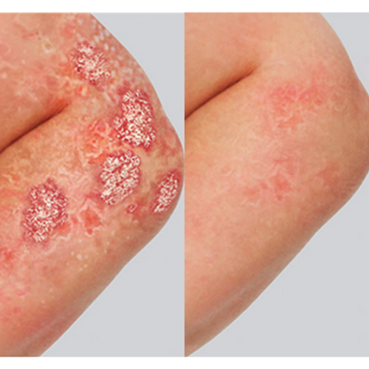 Psoriasis Spray KOLMAX®