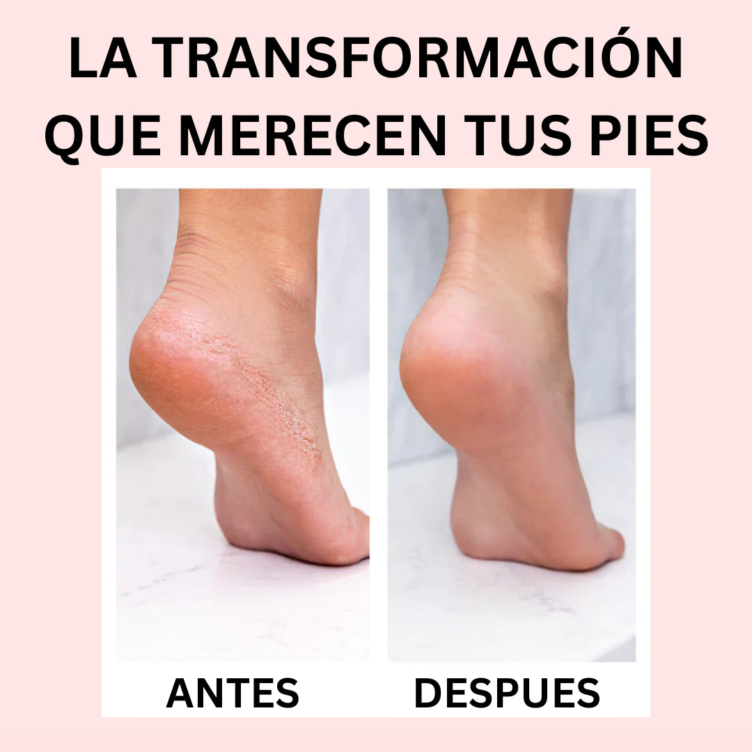 Removedor de Callos Eléctrico DermaClear™